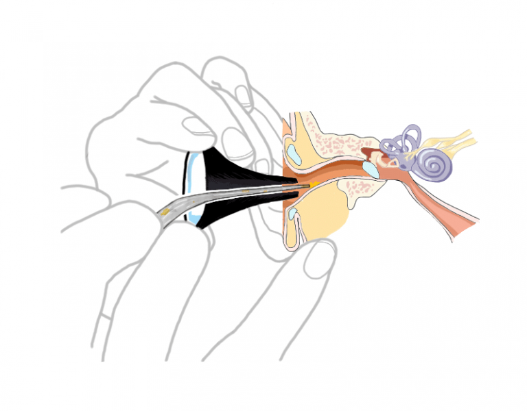 Microsuction Procedure Cerumen And Ear Wax Removal Cleaning And Suction